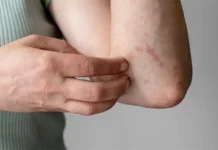 क्या त्वचा पर खुजली और पपड़ी है? हो सकता है ये फंगल इंफेक्शन हो क्या त्वचा पर खुजली और पपड़ी है? हो सकता है ये फंगल इंफेक्शन हो