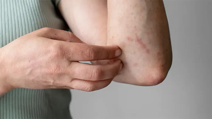 क्या त्वचा पर खुजली और पपड़ी है? हो सकता है ये फंगल इंफेक्शन हो