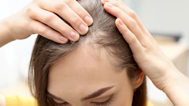 home-remedies-to-regrow-hair-on-bald-spots-1747217211662_v गंजेपन से परेशान? अपनाएं ये देसी नुस्खे, प्राकृतिक तरीके से दोबारा उगेंगे बाल