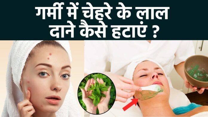 maxresdefault (1) गर्मी में त्वचा पर हो रहे दानों से परेशान? अपनाएं ये असरदार घरेलू नुस्खे