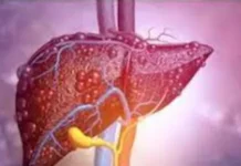 खानपान के अलावा ये गलतियां भी बढ़ाती हैं फैटी लिवर का खतरा खानपान के अलावा ये गलतियां भी बढ़ाती हैं फैटी लिवर का खतरा