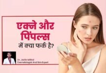 एक्ने और पिंपल्स में क्या है असली अंतर? ज्यादातर लोग नहीं जानते ये फर्क एक्ने और पिंपल्स में क्या है असली अंतर? ज्यादातर लोग नहीं जानते ये फर्क