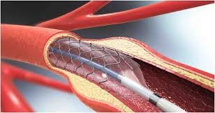 factrecorder बिना बेहोश किए हार्ट में स्टेंट डालना कितना संभव? सुष्मिता सेन के दावे पर डॉक्टरों ने दी स्पष्ट जानकारी