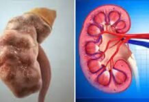 हाई ब्लड प्रेशर कैसे धीरे-धीरे किडनी को नुकसान पहुंचाता है? जानें इसके पीछे का वैज्ञानिक कारण हाई ब्लड प्रेशर कैसे धीरे-धीरे किडनी को नुकसान पहुंचाता है? जानें इसके पीछे का वैज्ञानिक कारणहाई ब्लड प्रेशर कैसे धीरे-धीरे किडनी को नुकसान पहुंचाता है? जानें इसके पीछे का वैज्ञानिक कारण