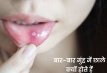 बार-बार मुंह में छाले: मामूली परेशानी या किसी गंभीर बीमारी का संकेत? जानिए कब हो जाएं सतर्क