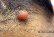 Health Tips: त्वचा पर उभार दिखे तो न करें अनदेखी, जानें गांठ, सूजन और फुंसी में क्या है असली फर्क