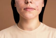 Causes Of Pimples: चेहरे पर बार-बार निकलते हैं मुंहासे? जानें असली वजह और बचाव के आसान तरीके