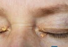 आंखों के आसपास पीले धब्बे: कारण, बीमारी और बचाव