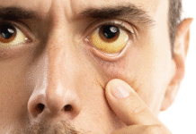 गोहर में पीलिया का कहर जारी, मंगलवार को 7 नए केस दर्ज