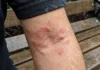 Skin Infection: बरसात में इन 5 गलतियों से बढ़ सकता है स्किन इंफेक्शन, जानें बचाव के आसान तरीके