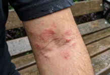 Skin Infection: बरसात में इन 5 गलतियों से बढ़ सकता है स्किन इंफेक्शन, जानें बचाव के आसान तरीके
