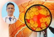 फैटी लिवर की पहचान कैसे करें? डॉक्टरों ने बताया खानपान से लेकर लाइफस्टाइल में क्या करें बदलाव